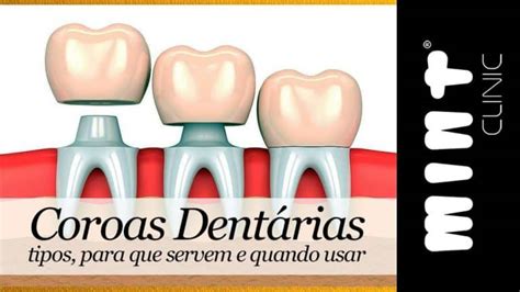 coroas fio dental|Entendendo as coroas dentárias: o que você precisa saber